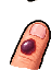 血泡